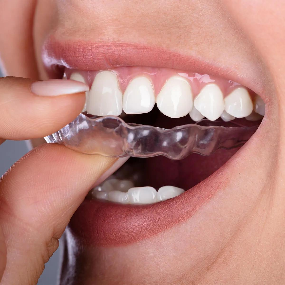 Where can I find affordable Invisalign in Brookfield?